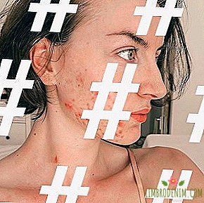 Hashtag trong ngày: Freethepimple - phong trào instagram tích cực trị mụn