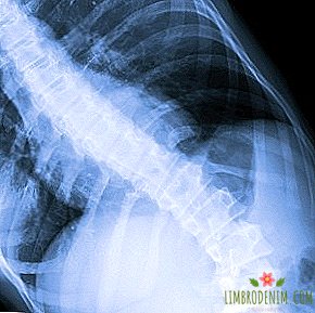 Lengkungan tulang belakang: Bagaimana saya telah berjuang dengan skoliosis sejak kecil