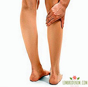 Varices: ¿De dónde vienen las "venas de la pierna" y cómo lidiar con ellas?