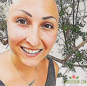 Livet med alopecia: Jeg mistet håret mitt, men fikk tro på meg selv